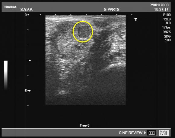 adenoma prostata ecografia